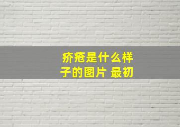 疥疮是什么样子的图片 最初